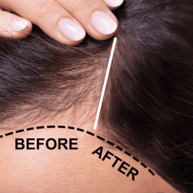 Featured Image Topdown Theory - Hair Restoration 增发技术