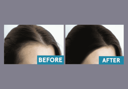 Hair Restoration1